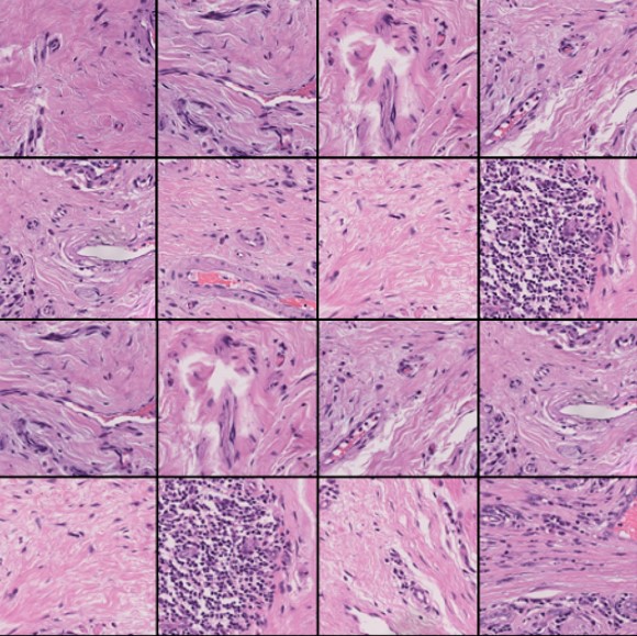 Tumor Detection (LNTD)