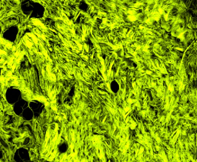 Tumor Recurrence (MILP)