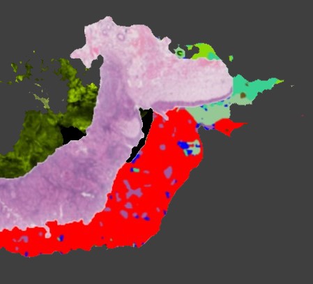 Tumor Segmentation (RNTS)